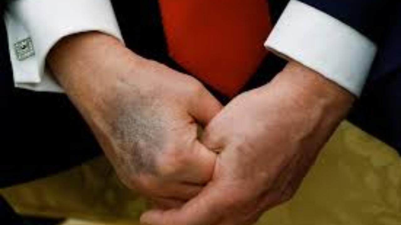 Trump Credits Daily Aspirin for Hand Bruises, Declares Health "Perfect"